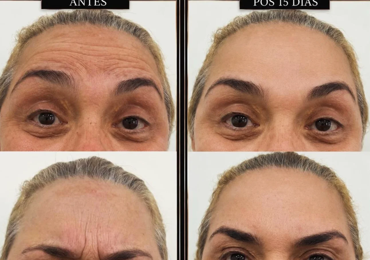 Antes e depois — caso 1