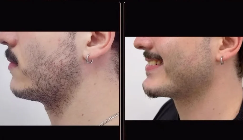 Antes e depois — caso 10
