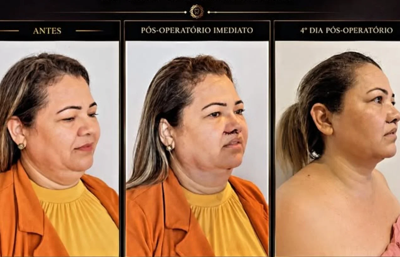 Antes e depois — caso 9